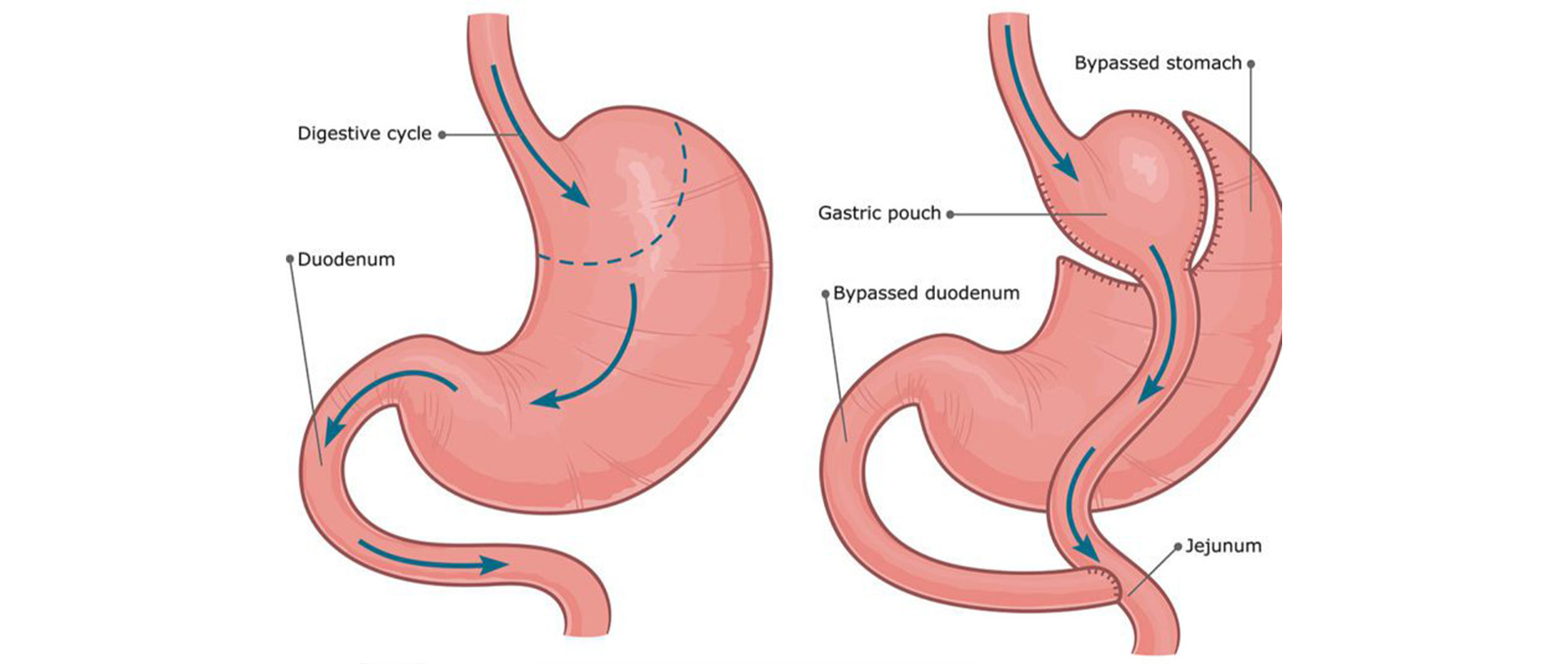 Gastrik - Bypass