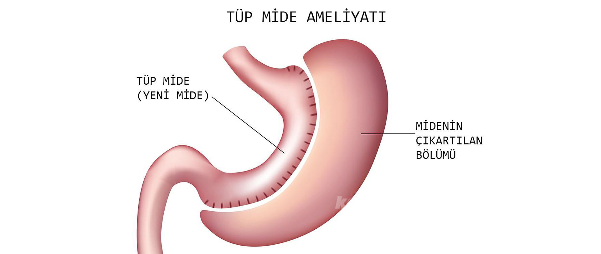 Tüp Mide Ameliyatı