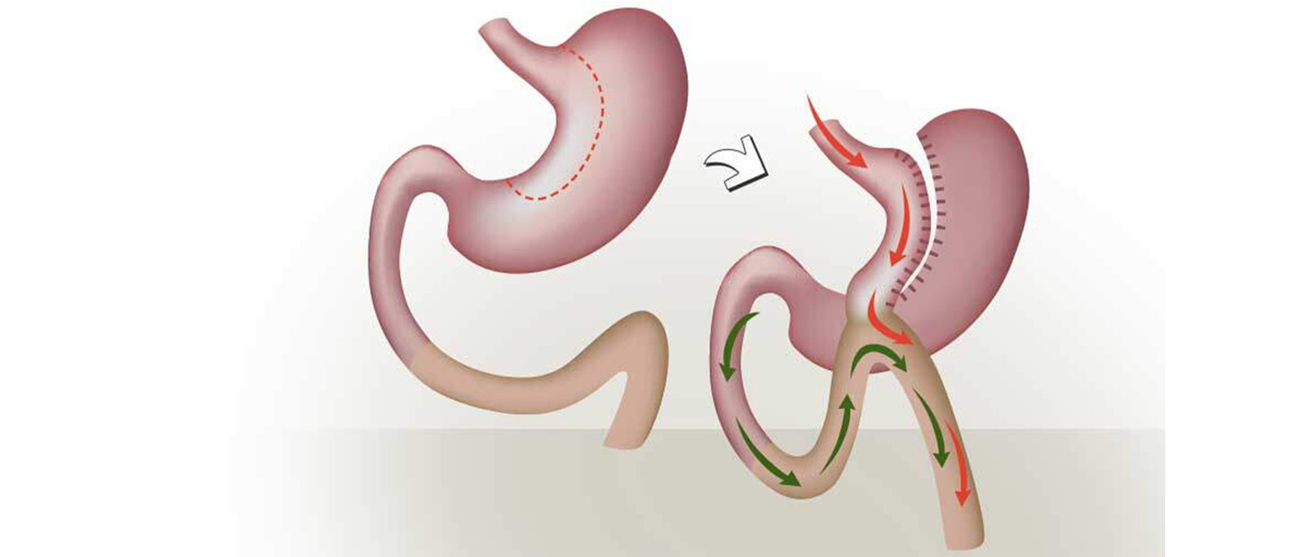 Mini Gastrik Bypass