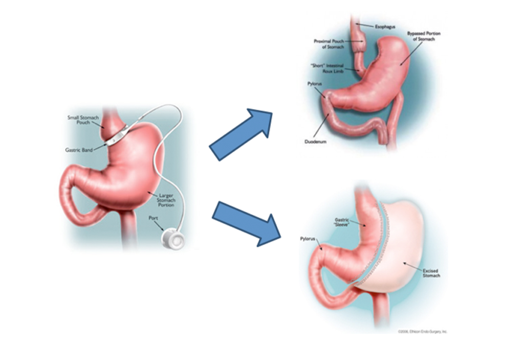 Gastrik Bypass ve Mini Gastrik Bypass Nedir? Farkları ve Uygulama Alanları