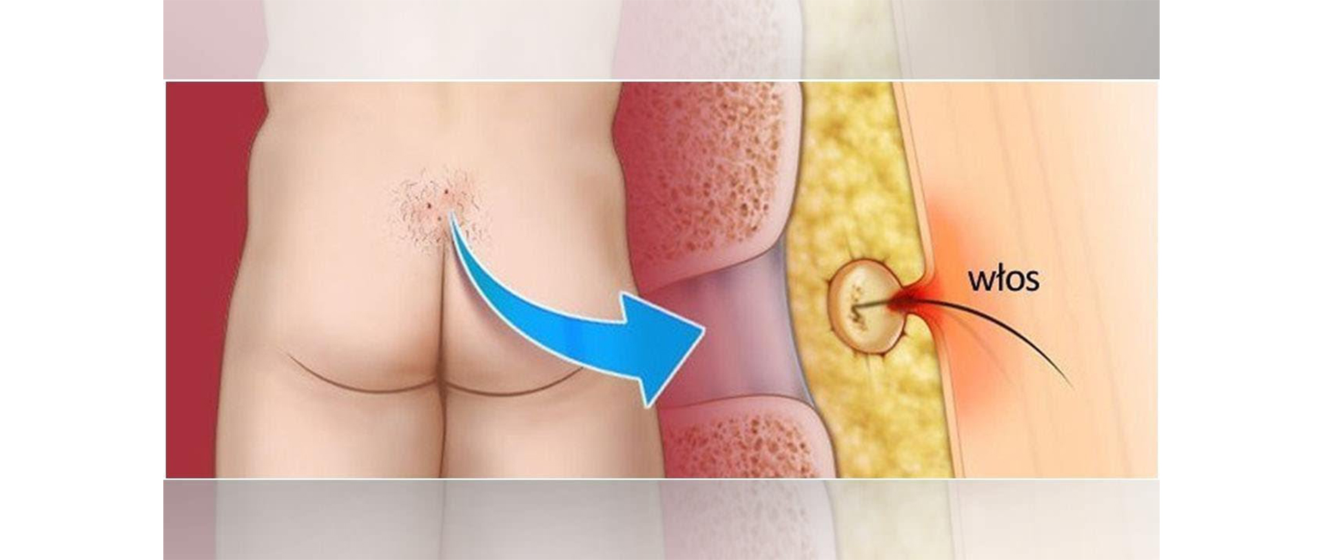Pilonidal Sinüs