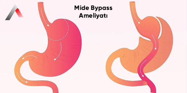 Tüp Mide ve Gastrik Bypass Ameliyatları: Farkları, Avantajları, Dezavantajları ve Hasta Seçimi
